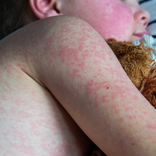 Measles conditions attain 33-three hundred and sixty five days high as RFK Jr. pursues anti-vaccine agenda