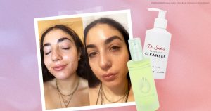 I’m on Accutane, and These Merchandise Solved All My Dry Pores and skin Concerns